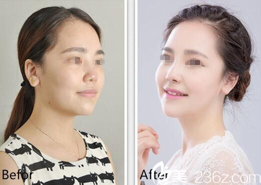 包涛隆鼻前后对比案例