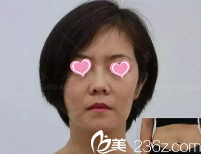 脸部凹陷显老态 脸部凹陷显老态