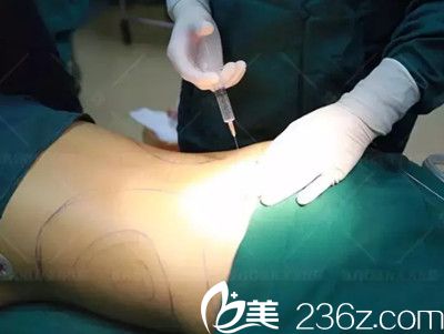 腰部吸脂之前打麻药 腰部吸脂之前打麻药