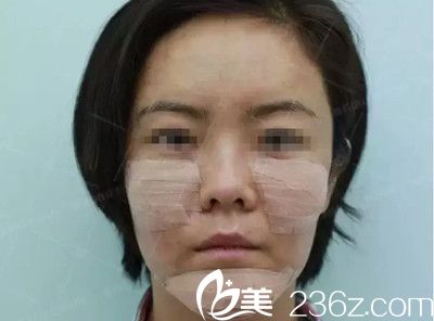 自体脂肪面部填充后包扎 自体脂肪面部填充后包扎