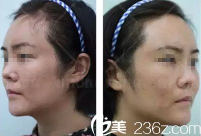 术后4天面部红肿 术后4天面部红肿