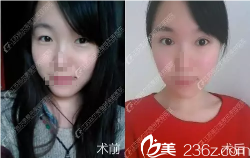 双眼皮加开眼角前后对比案例