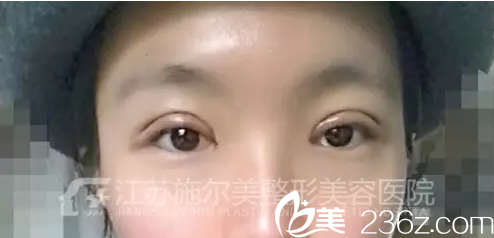 江苏施尔美双眼皮术后天效果