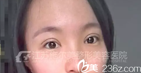 术后第六天双眼皮加开眼角还在恢复中