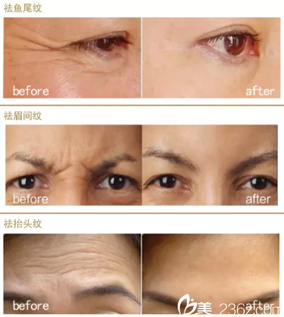 伊丽莎白整形苏炳云面部年轻化<span style= 伊丽莎白整形苏炳云面部年轻化<span style=