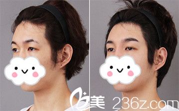 韩式三点双眼皮前后对比案例 韩式三点双眼皮前后对比案例