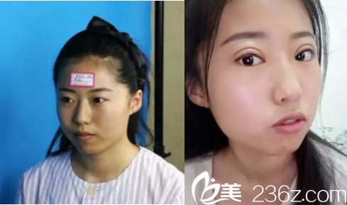 伊丽莎白整形何山双眼皮案例 伊丽莎白整形何山双眼皮案例