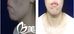 <!--<i data=20240703-sp></i>--><!--<i data=20240703-sp></i>-->垫下巴案例术前 <!--<i data=20240703-sp></i>--><!--<i data=20240703-sp></i>-->垫下巴案例术前