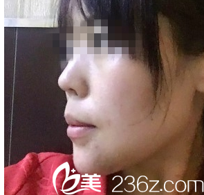 <!--<i data=20240703-sp></i>-->王金灿案例垫下巴术后效果 <!--<i data=20240703-sp></i>-->王金灿案例垫下巴术后效果