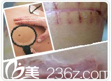 张家龙祛疤分型诊治 张家龙祛疤分型诊治