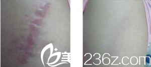 运用美学理念祛疤 运用美学理念祛疤