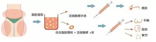 石家庄蓝山整形自体脂肪隆胸优惠价12600元