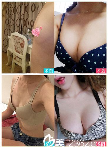 石家庄蓝山整形隆胸案例