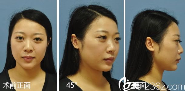 做鼻综合整形手术前的鼻子