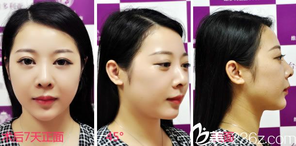 做鼻综合手术7天正侧面效果