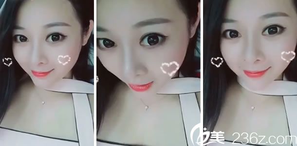 隆鼻手术第12天的效果图片