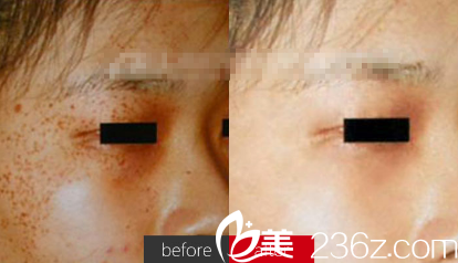 微针祛斑案例对比图 微针祛斑案例对比图