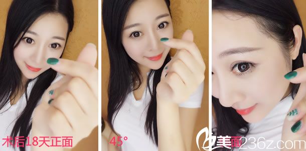 塌鼻子做手术第18天的效果