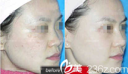 朗睿医学祛斑案例 朗睿医学祛斑案例