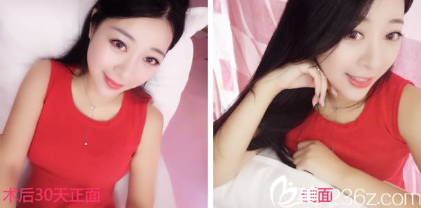 做鼻综合整形手术1个月照片