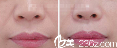 法令纹注射填充案例 法令纹注射填充案例