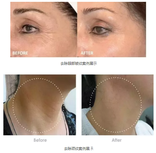 黄蓉医生除皱案例 黄蓉医生除皱案例