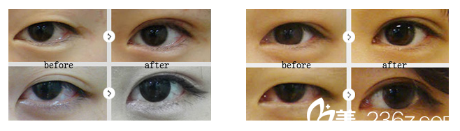 南宁华美卢志刚双眼皮案例 南宁华美卢志刚双眼皮案例