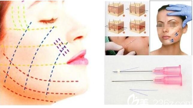 面部埋线提升原理 面部埋线提升原理