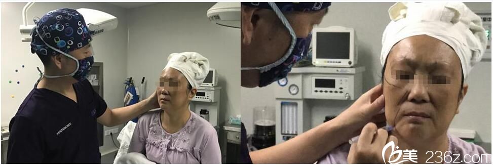 线雕手术前画线 线雕手术前画线