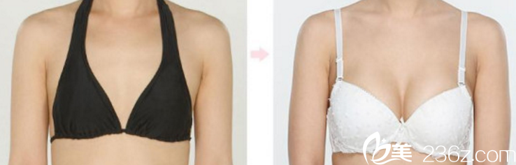 彭见生隆胸手术照 彭见生隆胸手术照