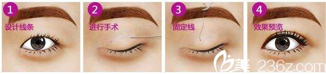 石家庄巍名仕韩式三点微创双眼皮现价2780元