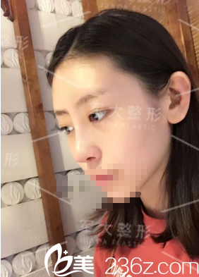 钟正强硅胶鼻综合术后5天恢复情况