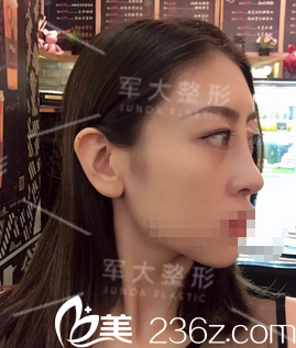 硅胶鼻综合手术拆线后效果