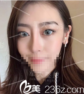 硅胶假体+耳软骨垫鼻尖1个月正面照