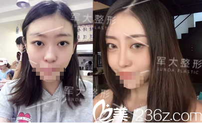 钟正强硅胶鼻综合术前术后对比照