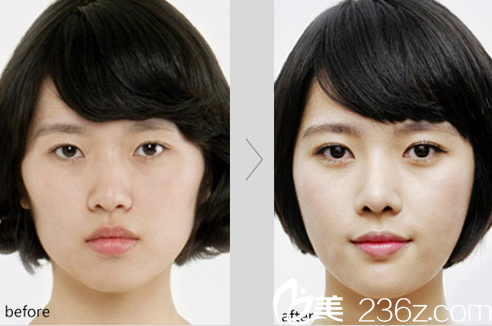 济南瑞丽医院双眼皮加开眼角特价3999元