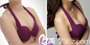 太原华美杨松林医生隆胸案例