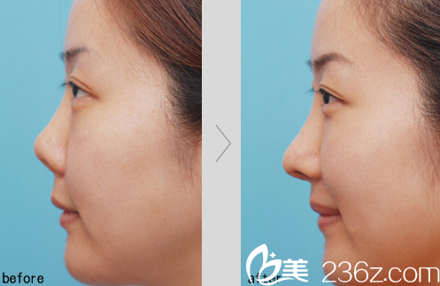 济南瑞丽医院假体隆鼻加耳软骨垫鼻尖爆款特价4999元