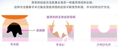 激光祛痣示意图