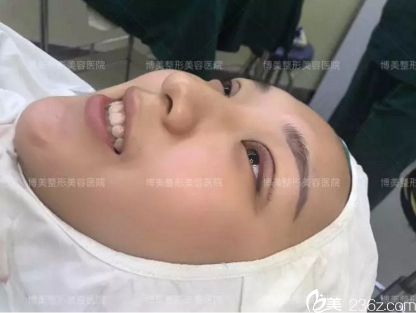 永州博美 双眼皮术后 永州博美 双眼皮术后