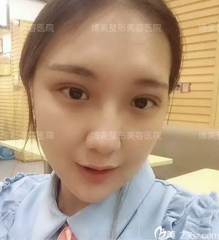 博美整形 做双眼皮怎么样? 博美整形 做双眼皮怎么样?