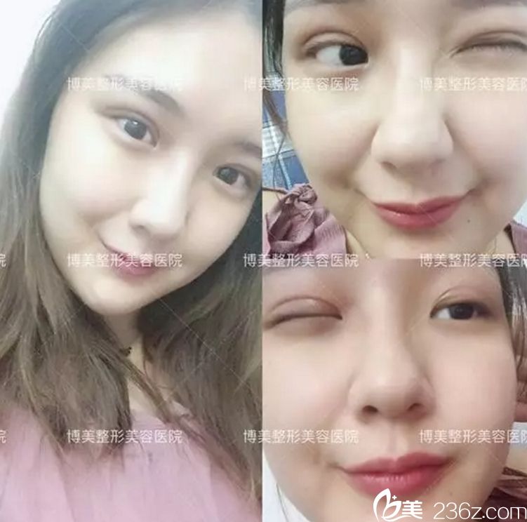 永州博美做双眼皮8天后 永州博美做双眼皮8天后