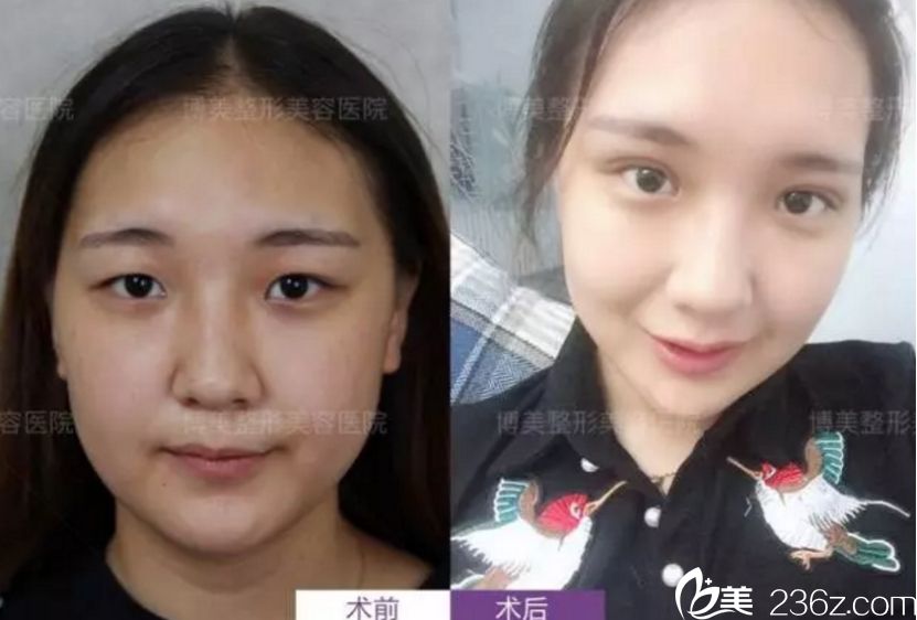 永州博美做双眼皮前后对比 永州博美做双眼皮前后对比