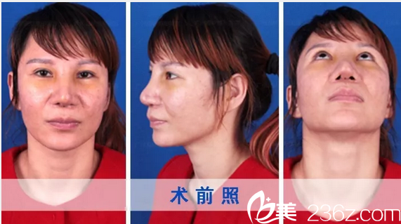 隆鼻失败修复术前照片 隆鼻失败修复术前照片