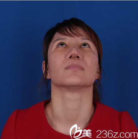 鼻修复术前抬头照 鼻修复术前抬头照