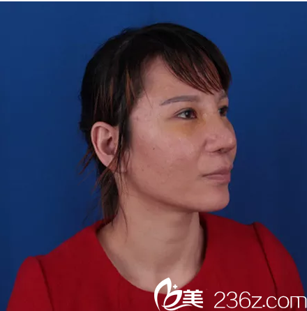 鼻修复术前侧面照片 鼻修复术前侧面照片