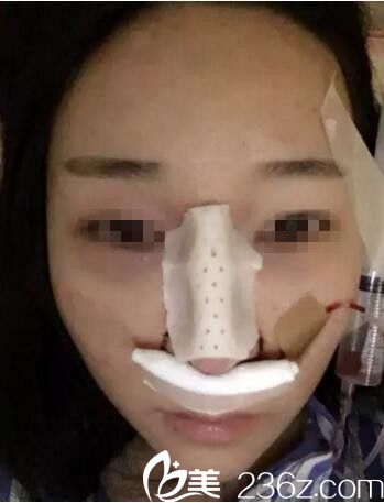 鼻综合术后即刻效果 鼻综合术后即刻效果