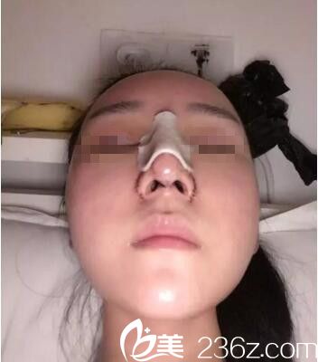 术后三天效果 术后三天效果