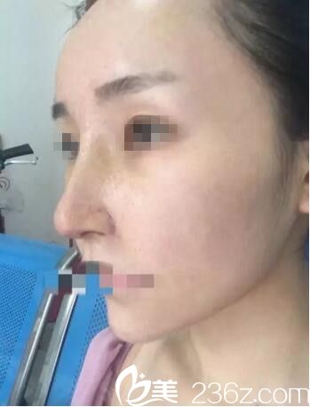 术后7前拆线效果 术后7前拆线效果