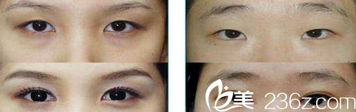 太原美媛荟李莉婷医师眼综合案例 太原美媛荟李莉婷医师眼综合案例